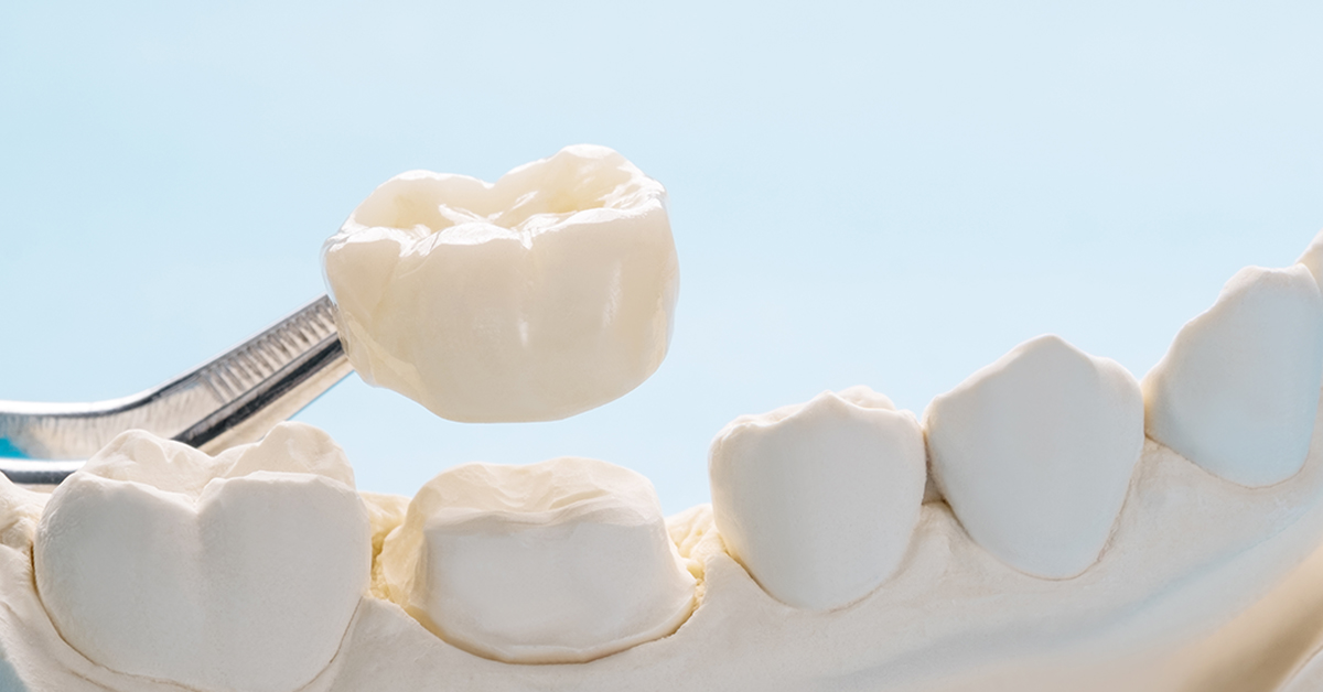 Read more about the article 全瓷冠、全鋯冠，假牙該怎麼選？常見的假牙材質比較